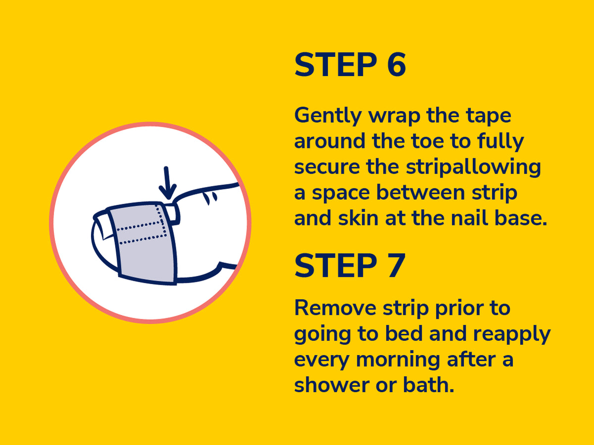 Ingrown Toenail 12-Hour Pain Relief Strips