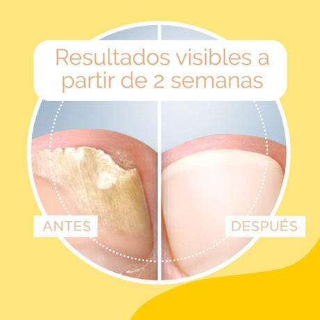 Scholl Tratamiento Anti-Hongos para uñas