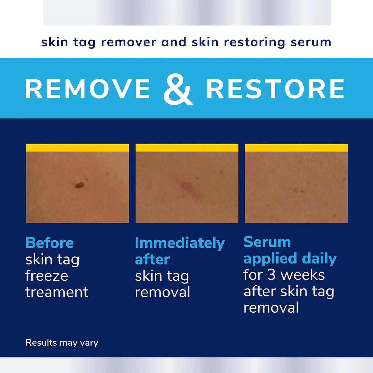 Scholl Aid Complete Care Skin Tag Removal Kit