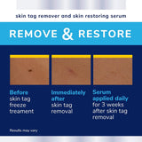 Scholl Aid Complete Care Skin Tag Removal Kit